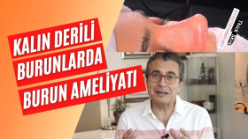 Kalın derili burunlarda burun ameliyatı süreci ve teknikleri hakkında bilgi veren video.